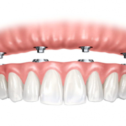 Prótese Dentária em Chapecó